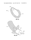 ADJUSTABLE ANNULOPLASTY RING AND ACTIVATION SYSTEM diagram and image