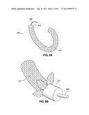 ADJUSTABLE ANNULOPLASTY RING AND ACTIVATION SYSTEM diagram and image