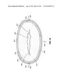 ADJUSTABLE ANNULOPLASTY RING AND ACTIVATION SYSTEM diagram and image