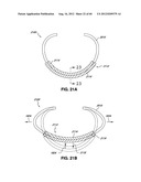 ADJUSTABLE ANNULOPLASTY RING AND ACTIVATION SYSTEM diagram and image