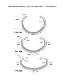 ADJUSTABLE ANNULOPLASTY RING AND ACTIVATION SYSTEM diagram and image