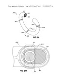 ADJUSTABLE ANNULOPLASTY RING AND ACTIVATION SYSTEM diagram and image