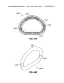 ADJUSTABLE ANNULOPLASTY RING AND ACTIVATION SYSTEM diagram and image