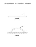 ADJUSTABLE ANNULOPLASTY RING AND ACTIVATION SYSTEM diagram and image