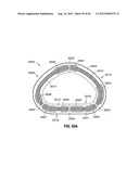 ADJUSTABLE ANNULOPLASTY RING AND ACTIVATION SYSTEM diagram and image