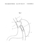 Medical Implant diagram and image