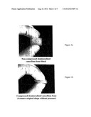 PROCESS FOR DEMINERALIZATION OF BONE MATRIX WITH PRESERVATION OF NATURAL     GROWTH FACTORS diagram and image