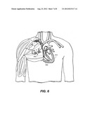 SYSTEMS AND METHODS FOR ESTIMATING CENTRAL ARTERIAL BLOOD PRESSURE OF A     PATIENT diagram and image