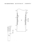 BARIATRIC SLEEVE diagram and image