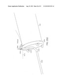 BARIATRIC SLEEVE diagram and image