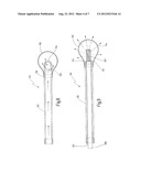 Balloon Catheter With Metal Shaft diagram and image