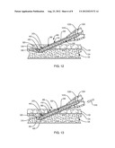 INTRAVASCULAR NEEDLE AND CATHETER ASSEMBLY diagram and image