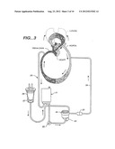 MULTICHANNEL CATHETER diagram and image