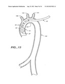 MULTICHANNEL CATHETER diagram and image