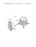 System and Method for Electrical Stimulation of the Lumbar Vertebral     Column diagram and image