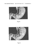 ENDOSCOPIC TISSUE APPOSITION DEVICE AND METHOD OF USE diagram and image