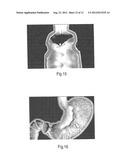 ENDOSCOPIC TISSUE APPOSITION DEVICE AND METHOD OF USE diagram and image