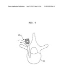 EXTENSIBLE PEDICLE SCREW COUPLING DEVICE diagram and image