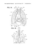 DEVICES AND METHODS FOR ELECTRICAL STIMULATION OF THE DIAPHRAGM AND NERVES diagram and image