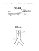 DEVICES AND METHODS FOR ELECTRICAL STIMULATION OF THE DIAPHRAGM AND NERVES diagram and image