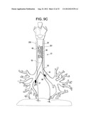 DEVICES AND METHODS FOR ELECTRICAL STIMULATION OF THE DIAPHRAGM AND NERVES diagram and image