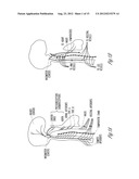 SYSTEM AND METHOD FOR SUSTAINED BAROREFLEX STIMULATION diagram and image