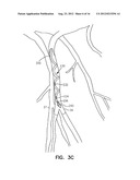 CORONARY VEIN LEADS HAVING PRE-FORMED BIASED PORTIONS FOR FIXATION diagram and image