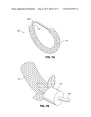 ADJUSTABLE ANNULOPLASTY RING AND ACTIVATION SYSTEM diagram and image