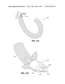 ADJUSTABLE ANNULOPLASTY RING AND ACTIVATION SYSTEM diagram and image