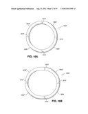 ADJUSTABLE ANNULOPLASTY RING AND ACTIVATION SYSTEM diagram and image