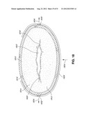 ADJUSTABLE ANNULOPLASTY RING AND ACTIVATION SYSTEM diagram and image