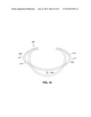 ADJUSTABLE ANNULOPLASTY RING AND ACTIVATION SYSTEM diagram and image