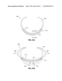 ADJUSTABLE ANNULOPLASTY RING AND ACTIVATION SYSTEM diagram and image