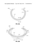 ADJUSTABLE ANNULOPLASTY RING AND ACTIVATION SYSTEM diagram and image