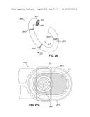 ADJUSTABLE ANNULOPLASTY RING AND ACTIVATION SYSTEM diagram and image