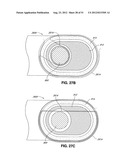 ADJUSTABLE ANNULOPLASTY RING AND ACTIVATION SYSTEM diagram and image