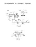 ADJUSTABLE ANNULOPLASTY RING AND ACTIVATION SYSTEM diagram and image