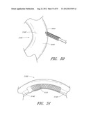 ADJUSTABLE ANNULOPLASTY RING AND ACTIVATION SYSTEM diagram and image