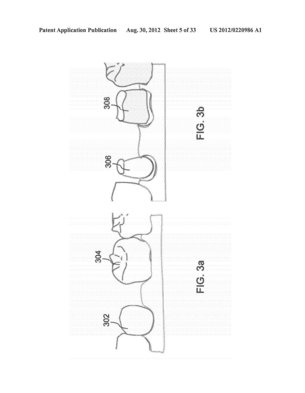 DEVICES AND METHODS FOR INTRAORAL CONTROLLED DRUG RELEASE - diagram, schematic, and image 06