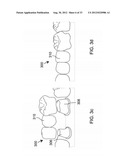 DEVICES AND METHODS FOR INTRAORAL CONTROLLED DRUG RELEASE diagram and image