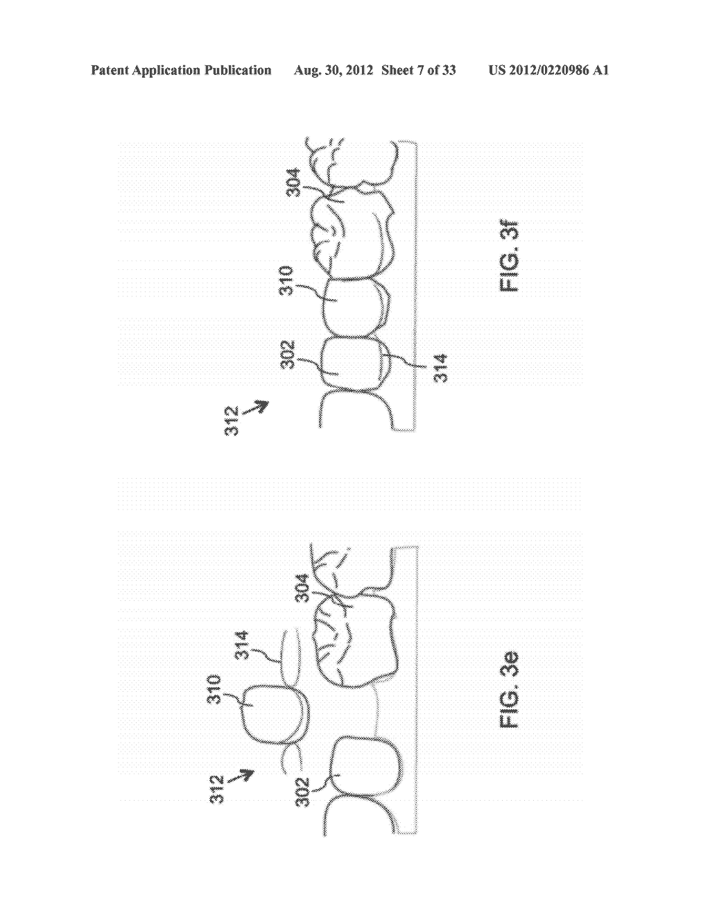 DEVICES AND METHODS FOR INTRAORAL CONTROLLED DRUG RELEASE - diagram, schematic, and image 08