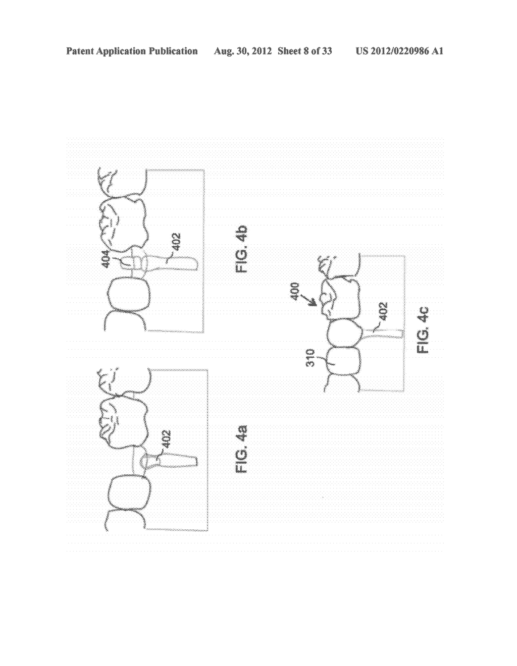 DEVICES AND METHODS FOR INTRAORAL CONTROLLED DRUG RELEASE - diagram, schematic, and image 09