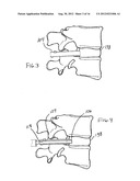 Method for Manipulating Intervertebral Tissue diagram and image