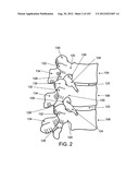 ARTICULATING TISSUE REMOVAL SYSTEMS AND METHODS diagram and image