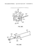 ARTICULATING TISSUE REMOVAL SYSTEMS AND METHODS diagram and image