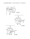 ARTICULATING TISSUE REMOVAL SYSTEMS AND METHODS diagram and image