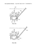 ARTICULATING TISSUE REMOVAL SYSTEMS AND METHODS diagram and image