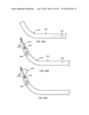 ARTICULATING TISSUE REMOVAL SYSTEMS AND METHODS diagram and image