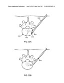 ARTICULATING TISSUE REMOVAL SYSTEMS AND METHODS diagram and image