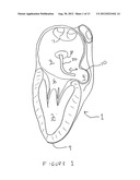 Methods And Devices For Treating The Left Atrial Appendage diagram and image